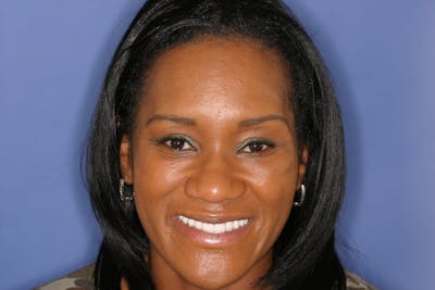 FloridasSmiles Porcelain Veneers Gallery patient