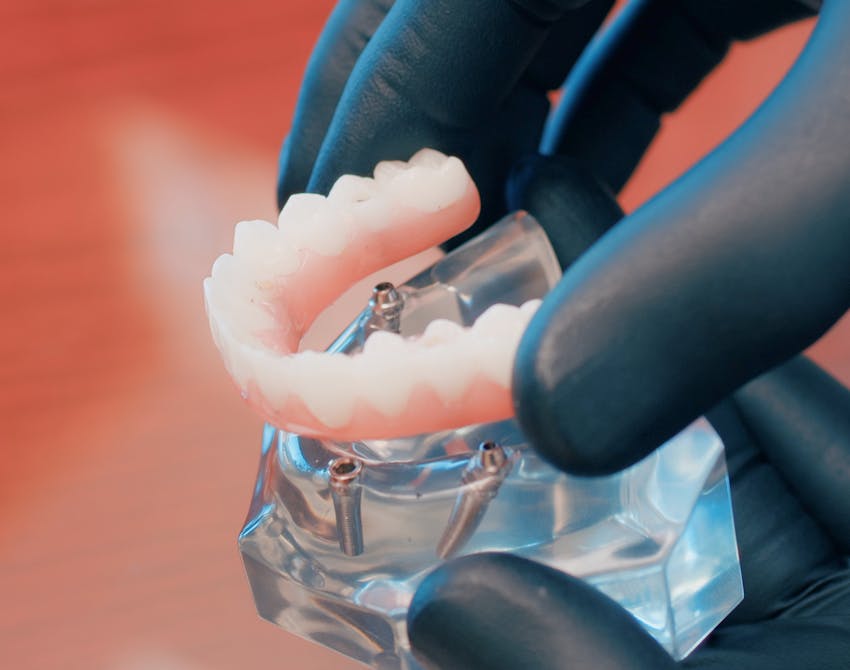 all-on-four dental implant