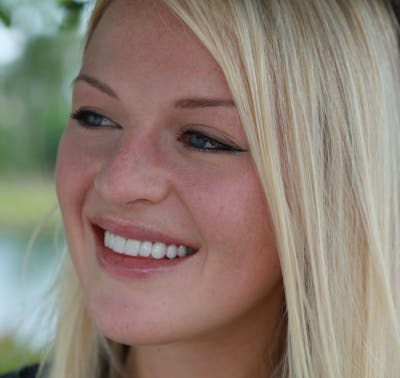 FloridasSmiles Porcelain Veneers Gallery patient