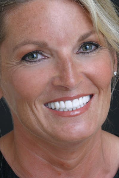 FloridasSmiles Porcelain Veneers Gallery patient