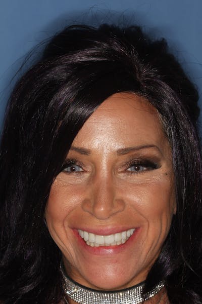 FloridasSmiles All-on-X Gallery patient