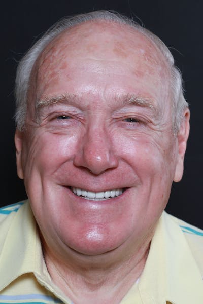 FloridasSmiles Porcelain Veneers Gallery patient