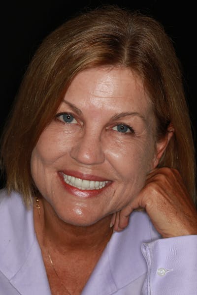 FloridasSmiles Porcelain Veneers Gallery patient