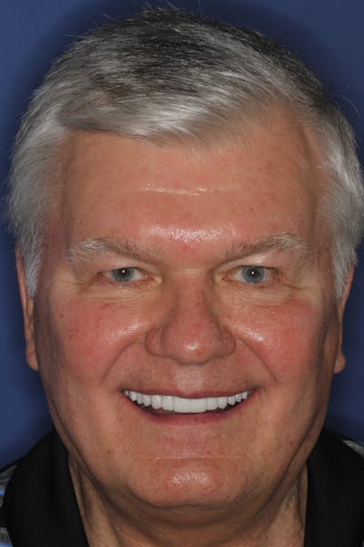 FloridasSmiles Porcelain Veneers Gallery patient