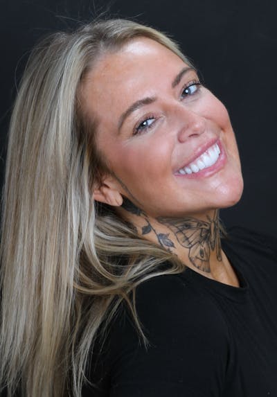 FloridasSmiles All-on-X Gallery patient