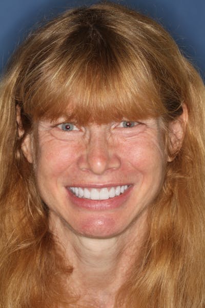 FloridasSmiles Porcelain Veneers Gallery patient