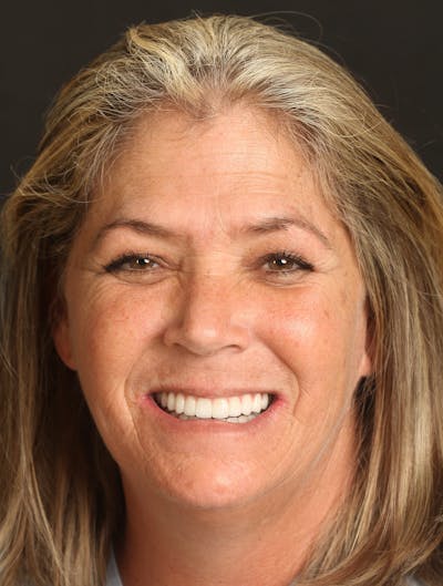 FloridasSmiles All-on-X Gallery patient