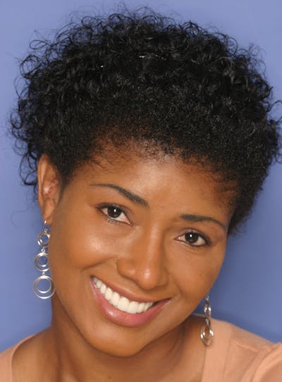 FloridasSmiles Porcelain Veneers Gallery patient