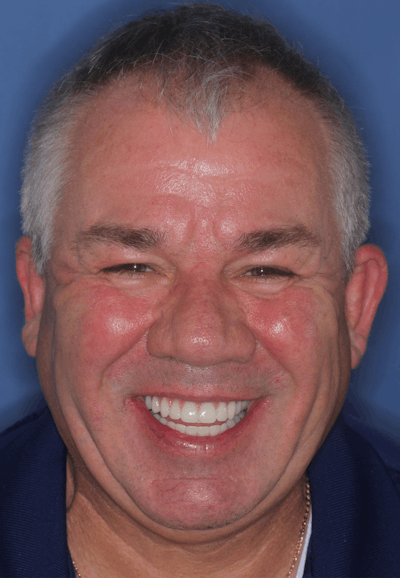 FloridasSmiles All-on-X Gallery patient