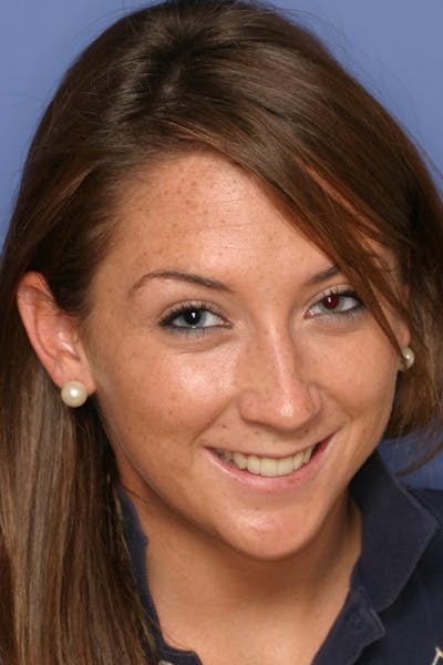 FloridasSmiles Porcelain Veneers Gallery patient