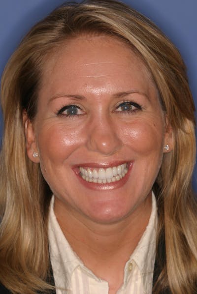 FloridasSmiles Porcelain Veneers Gallery patient