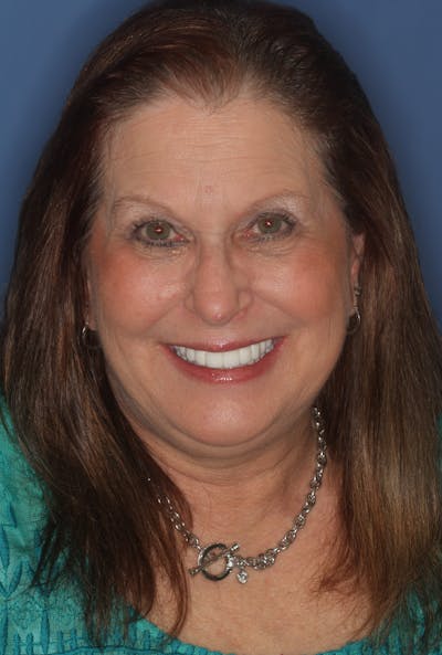 FloridasSmiles All-on-X Gallery patient