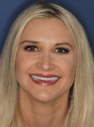 FloridasSmiles Porcelain Veneers Gallery patient