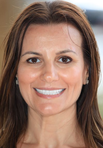 FloridasSmiles Porcelain Veneers Gallery patient