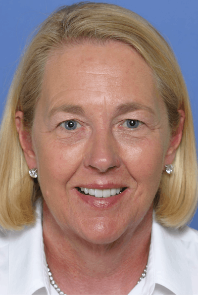 FloridasSmiles Porcelain Veneers Gallery patient