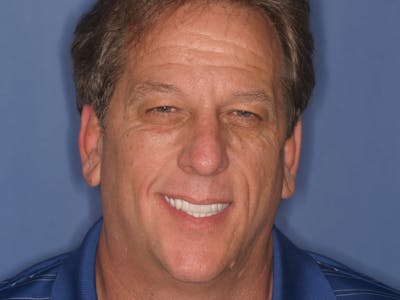 FloridasSmiles Porcelain Veneers Gallery patient