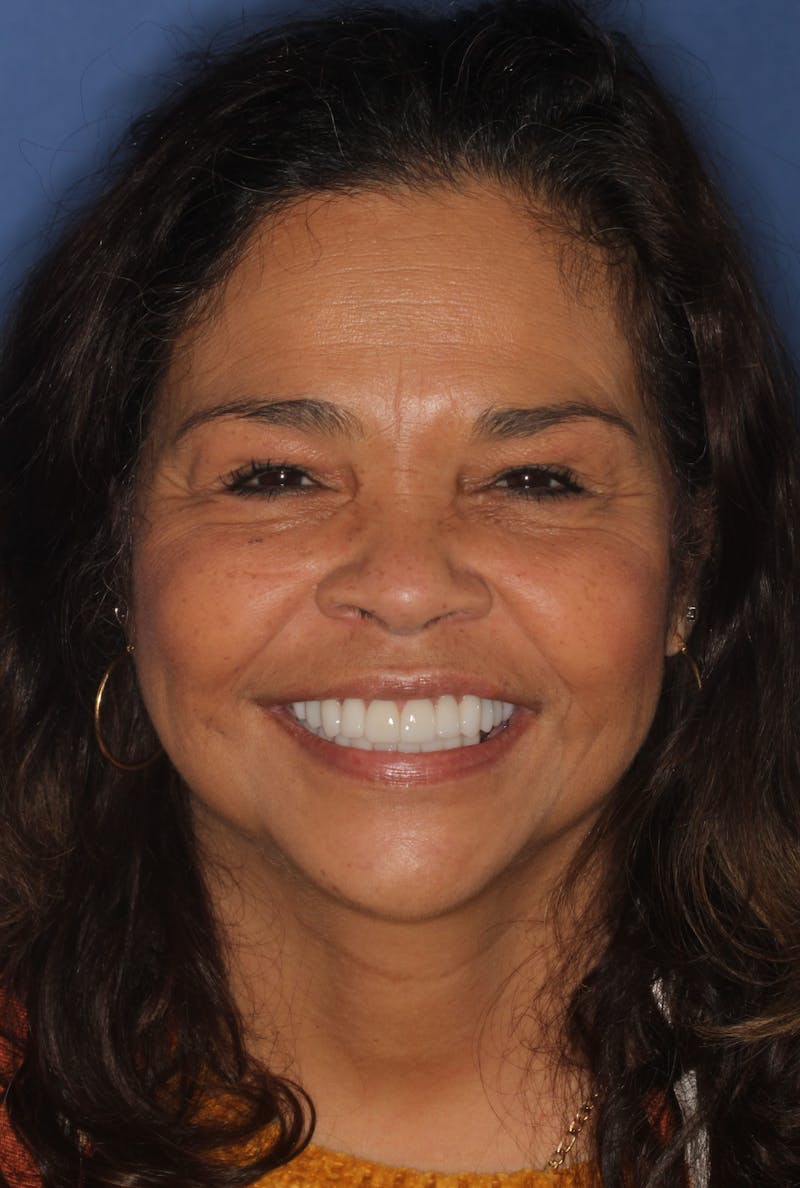 FloridasSmiles Smile Gallery patient