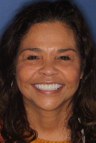 FloridasSmiles Porcelain Veneers Gallery patient