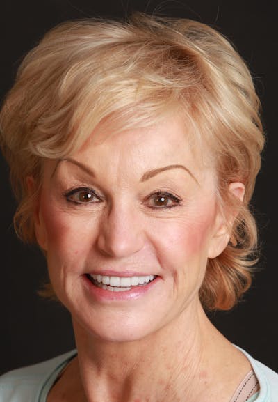 FloridasSmiles Porcelain Veneers Gallery patient