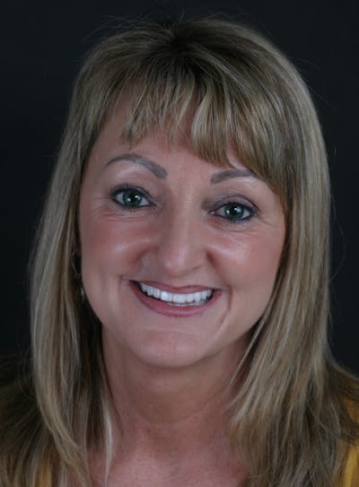 FloridasSmiles Porcelain Veneers Gallery patient