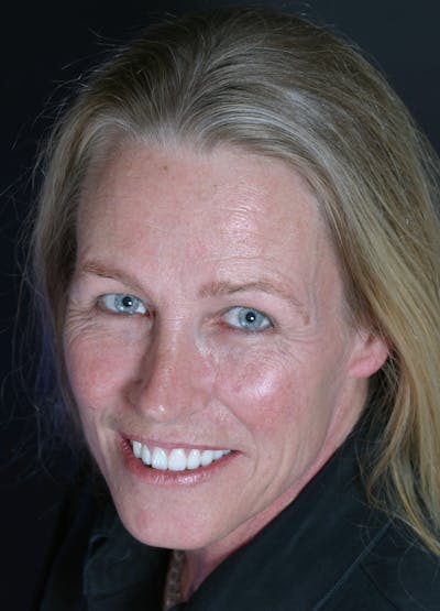 FloridasSmiles Porcelain Veneers Gallery patient