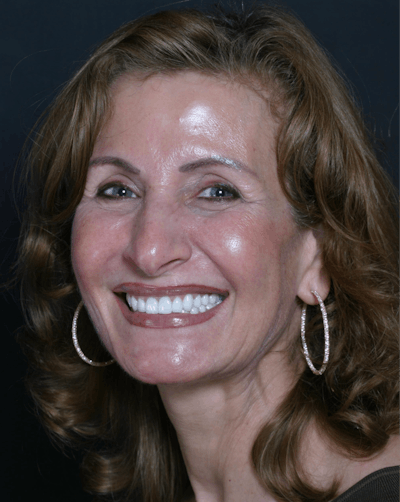 FloridasSmiles Porcelain Veneers Gallery patient