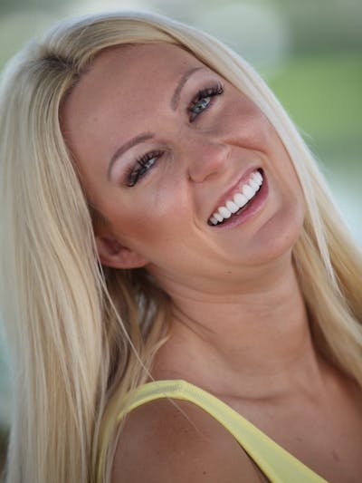 FloridasSmiles Porcelain Veneers Gallery patient