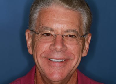 FloridasSmiles Porcelain Veneers Gallery patient