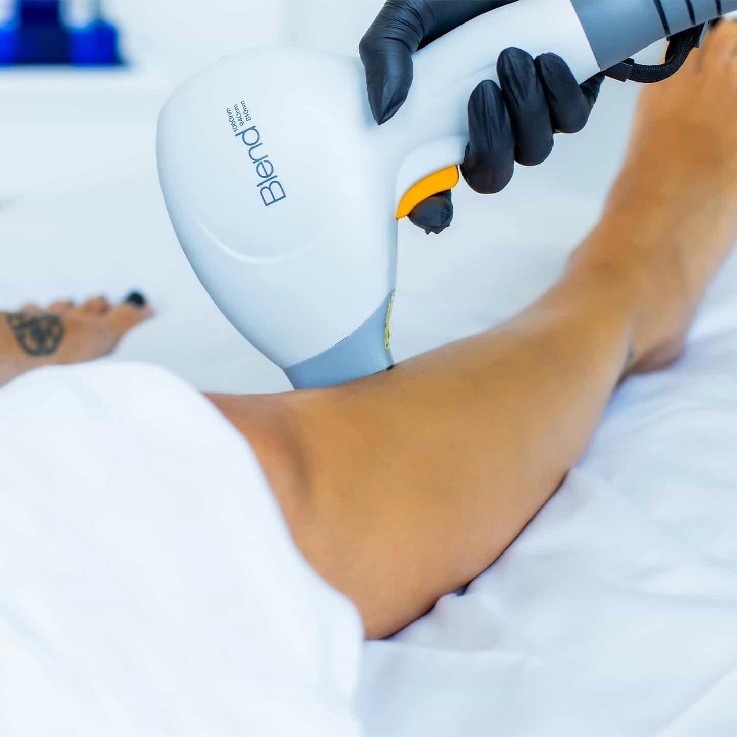 Laser hair removal treatment on leg