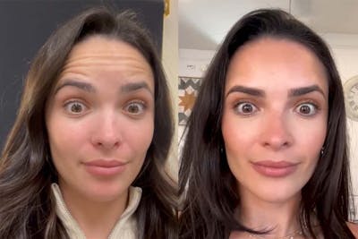 BOTOX Before & After Gallery - Patient 178956 - Image 1