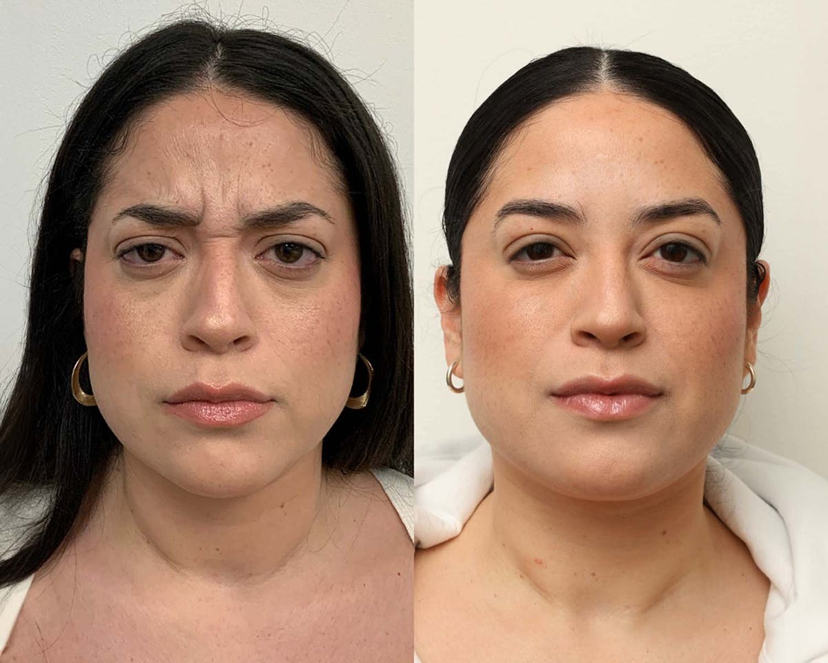 BOTOX Before & After Gallery - Patient 966739 - Image 1