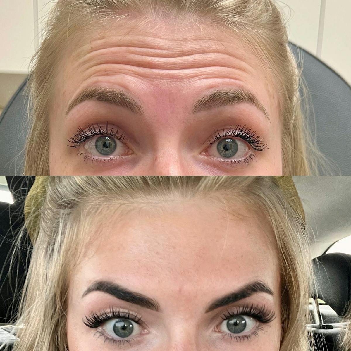 BOTOX Before & After Gallery - Patient 110803 - Image 1