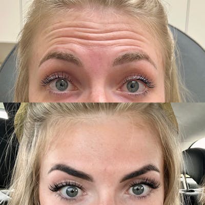 BOTOX Before & After Gallery - Patient 110803 - Image 1