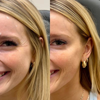 BOTOX Before & After Gallery - Patient 125341 - Image 1