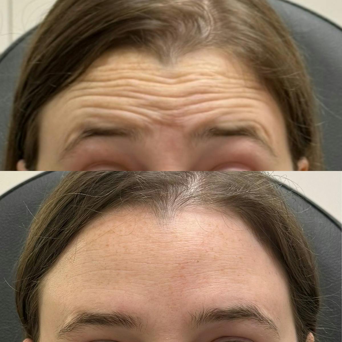 BOTOX Before & After Gallery - Patient 379204 - Image 1
