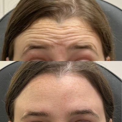 BOTOX Before & After Gallery - Patient 379204 - Image 1