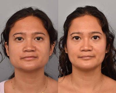 BOTOX Before & After Gallery - Patient 321416 - Image 1