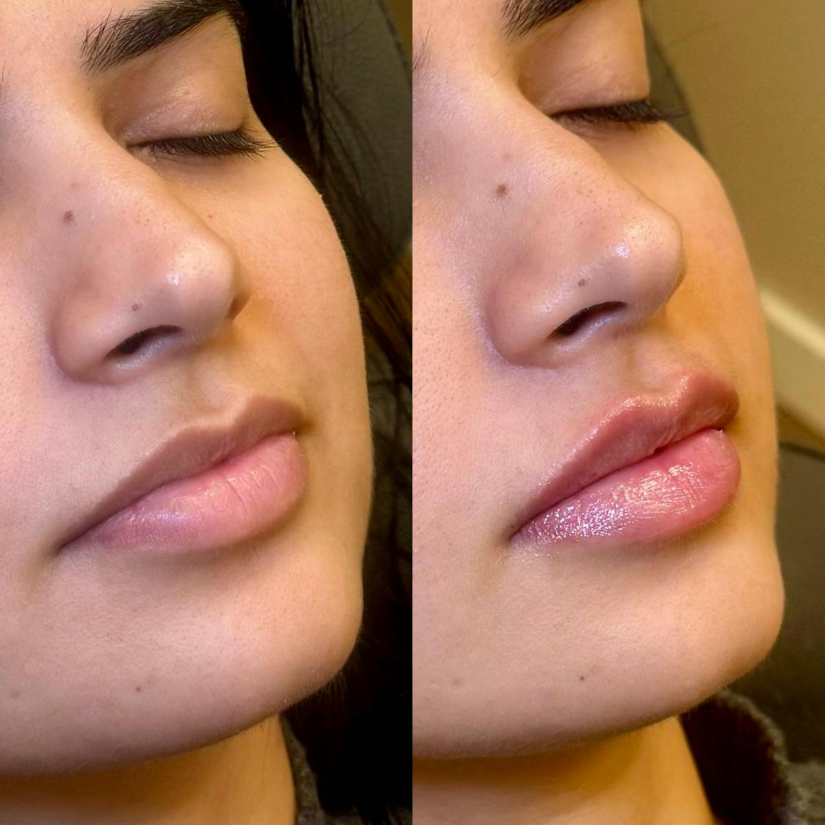 Fillers Before & After Gallery - Patient 348888 - Image 1