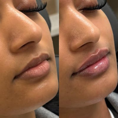 BOTOX Before & After Gallery - Patient 343013 - Image 1