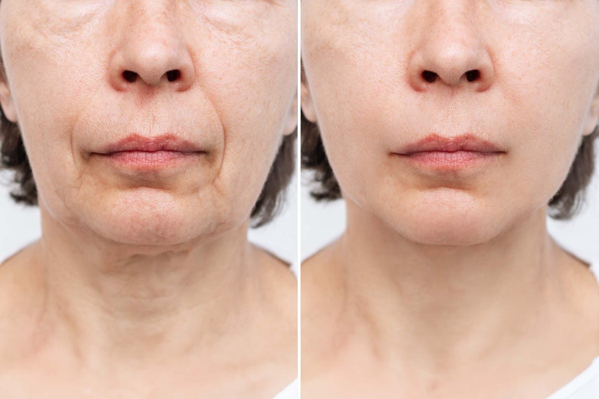 Facelift Before & After Gallery - Patient 106347 - Image 1