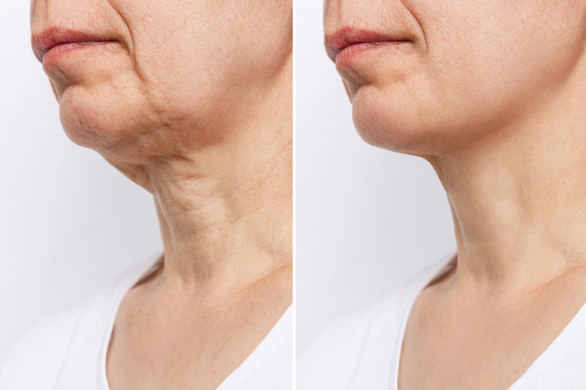 Facelift Before & After Gallery - Patient 215813 - Image 1