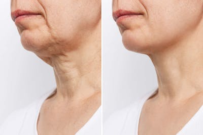 Facelift Before & After Gallery - Patient 215813 - Image 1