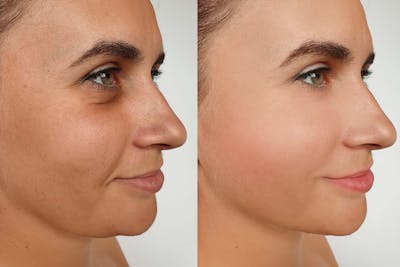Facelift Before & After Gallery - Patient 293281 - Image 1