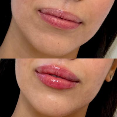 Fillers Before & After Gallery - Patient 305948 - Image 1