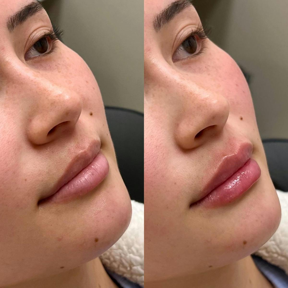 Fillers Before & After Gallery - Patient 392478 - Image 1
