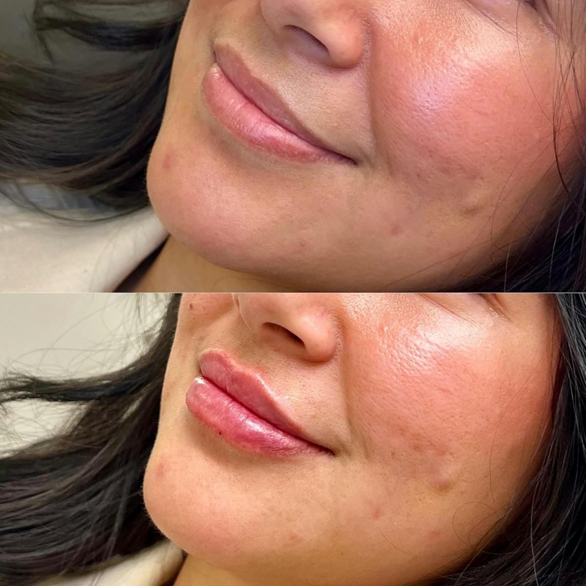 Fillers Before & After Gallery - Patient 287413 - Image 1