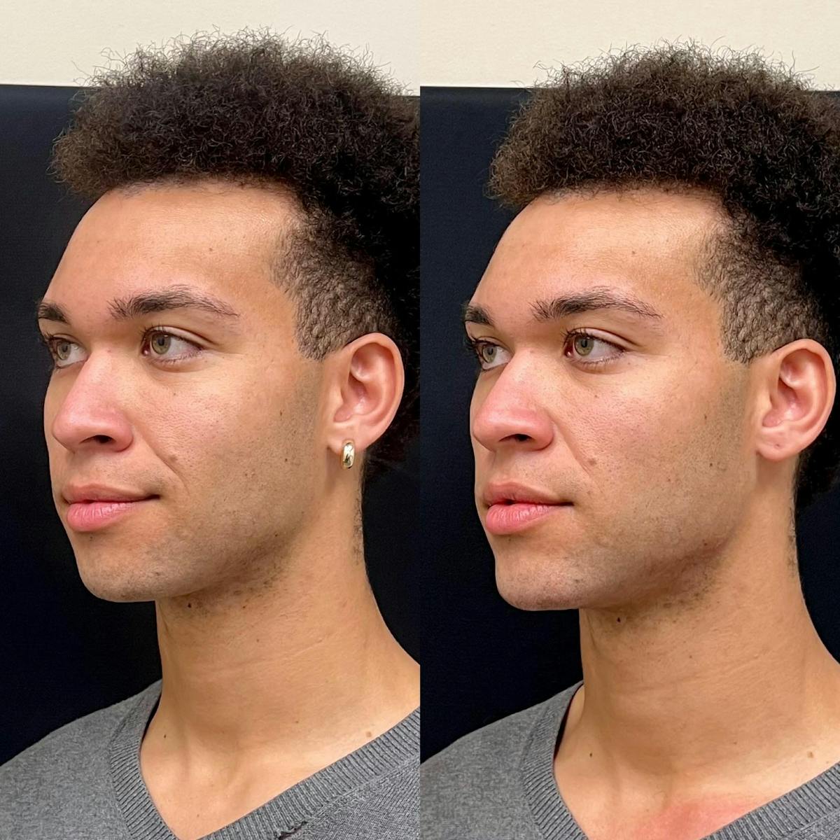 Fillers Before & After Gallery - Patient 416611 - Image 1