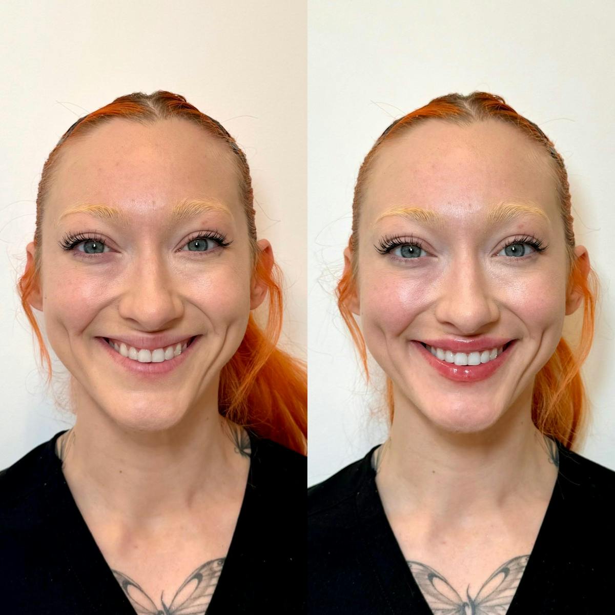 Fillers Before & After Gallery - Patient 351857 - Image 1