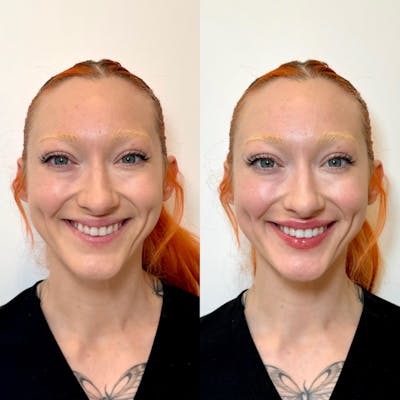 Fillers Before & After Gallery - Patient 351857 - Image 1