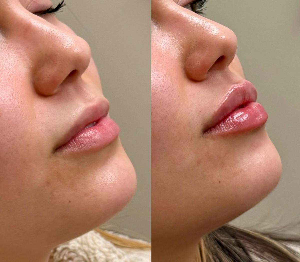 Fillers Before & After Gallery - Patient 965978 - Image 1